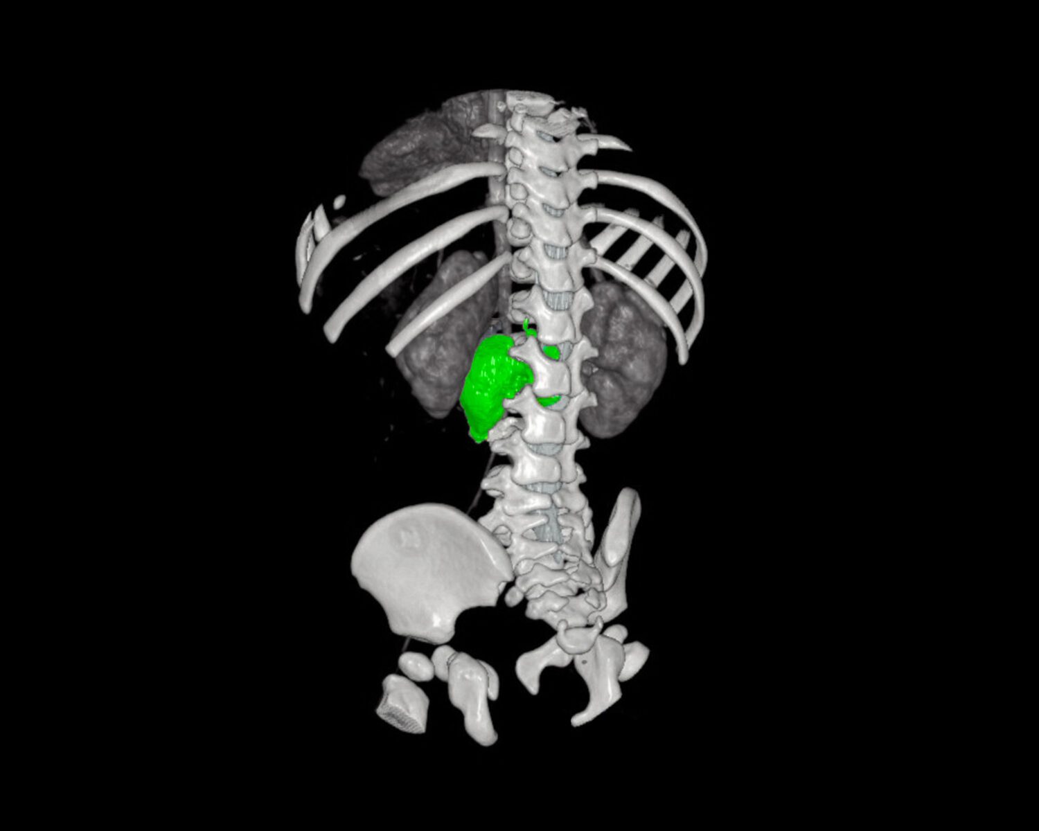 Neuroblastoma 3D